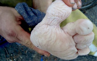 This is a pretty severe case of immersion foot that comes from feet that are constantly wet. It can be a dangerous condition if not treated quickly. I dried his feet and slowly rewarmed them and gave him dry socks and shoes. He is now being evaluated in the ER and we will continue to follow him.